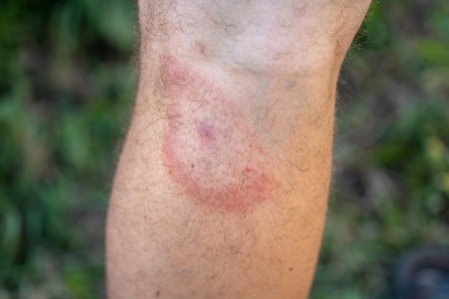 hiking health - A ‘bull’s eye’ rash can be a sign of Lyme disease. Credit: Alexey Androsov / Shutterstock
